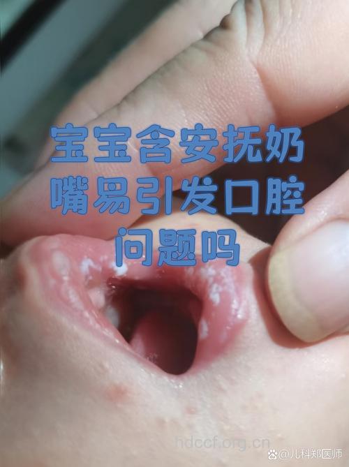 奶嘴对宝宝口腔有什么影响
