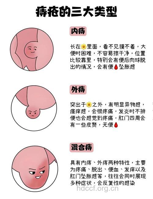 内痔的主要症状表现