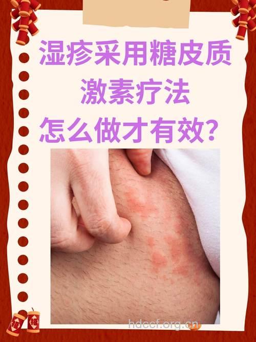 激素治疗湿疹已成历史