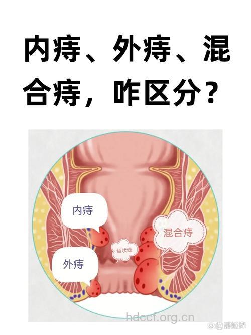 各种类型的痔疮有什么区别