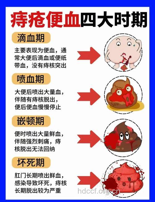 女性痔疮便血的诊断标准