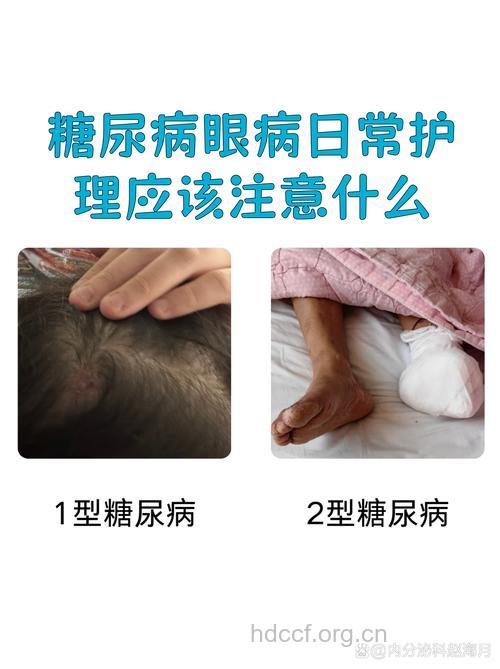 糖尿病眼部怎么护理