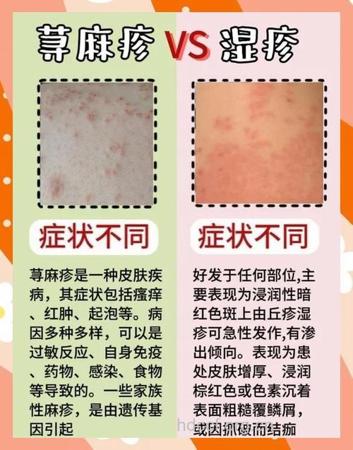 荨麻疹反复越挠越痒怎么办