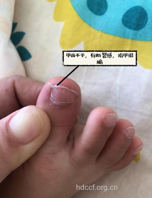 看指甲知宝宝疾病
