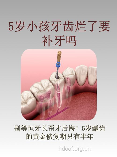 儿童乳牙坏了到底要不要治