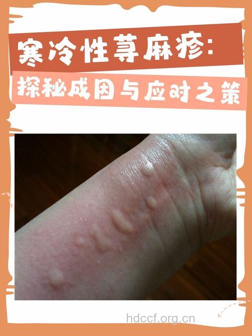 冬季要小心寒冷性荨麻疹