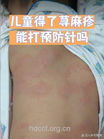 X线检查会引起荨麻疹吗