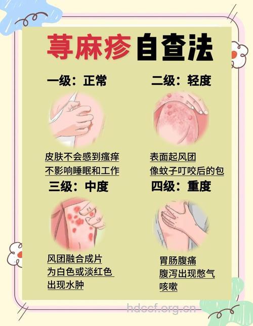 别把荨麻疹当成急性肠胃炎