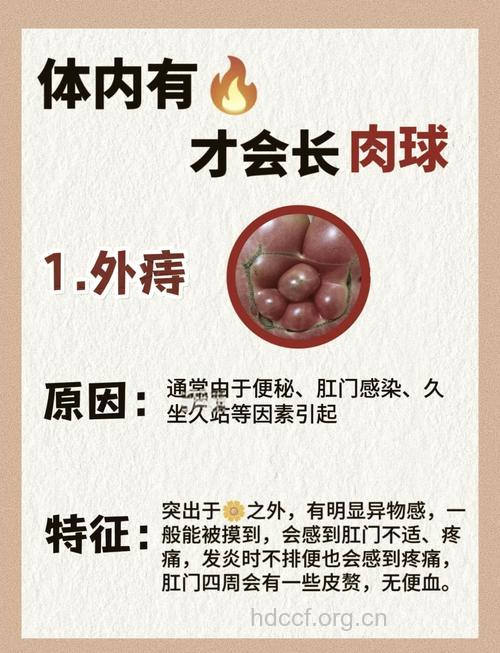 外痔疮是怎么发生的