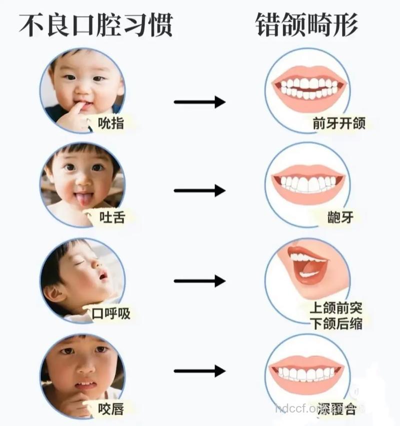 儿童不良口腔习惯易致牙畸形