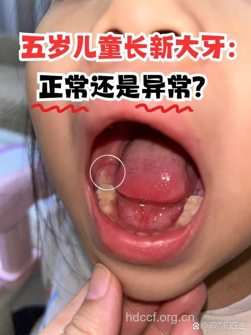 孩子长出“大板牙”　是不是病？