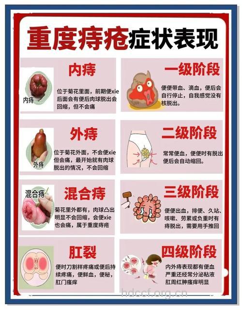 痔疮疾病如何进行分类