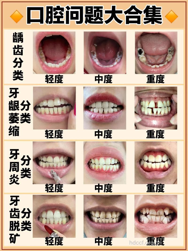 当代国人最常见4种口腔疾病