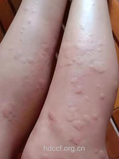 X线检查能诱发荨麻疹吗