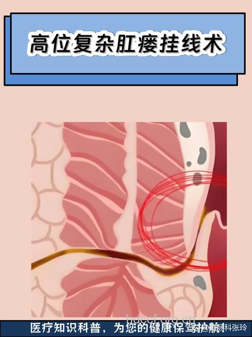 肛瘘的无痛疗法有哪些