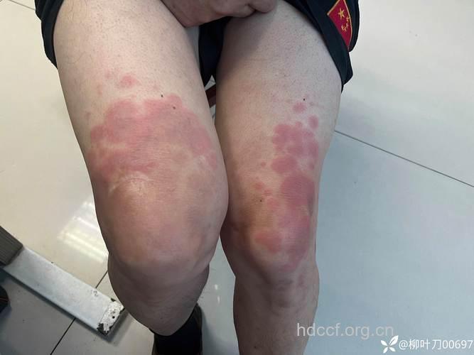 红斑狼疮并发的荨麻疹的症状