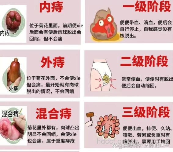 分析良性病变的痔疮