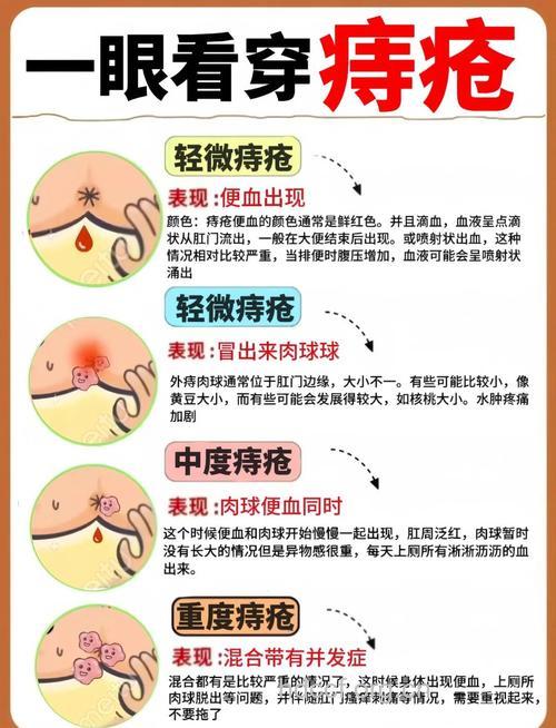 混合痔怎么自我诊断