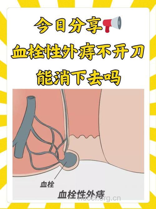 什么是血栓性外痔
