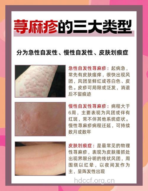 怎么区别诊断压力性荨麻疹