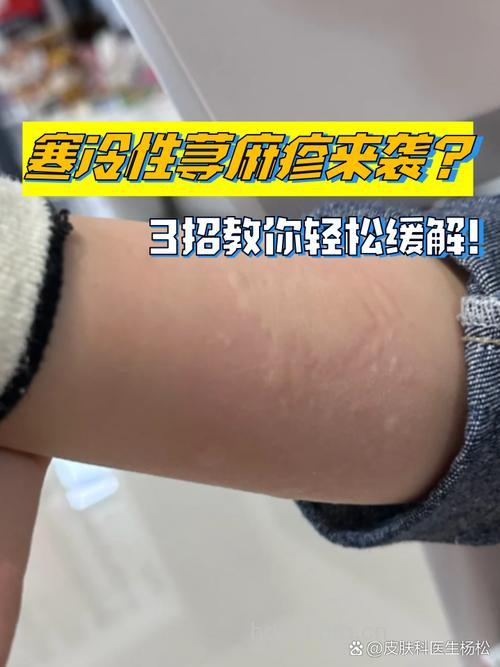 天冷慎防荨麻疹“作乱”