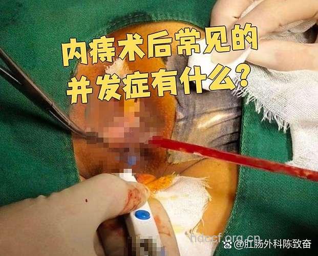 痔疮术后的并发症
