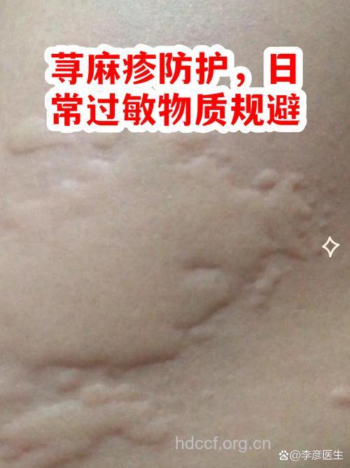 戴个口罩驱荨麻疹