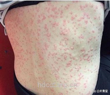 食物+药物“催化”出荨麻疹