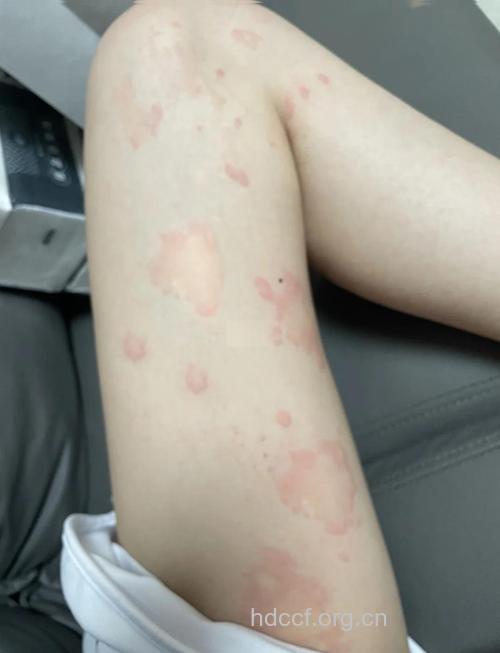 自己的血治好荨麻疹