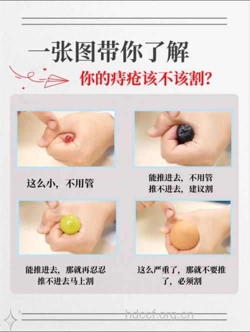 怎么认清痔疮的真实面目