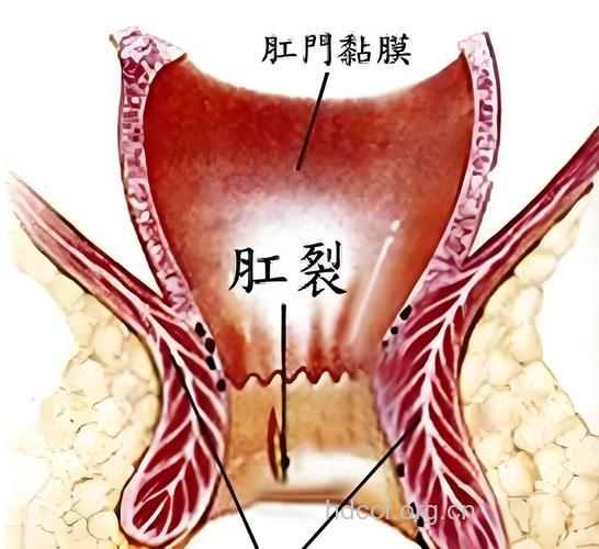 肛裂病变的各个阶段