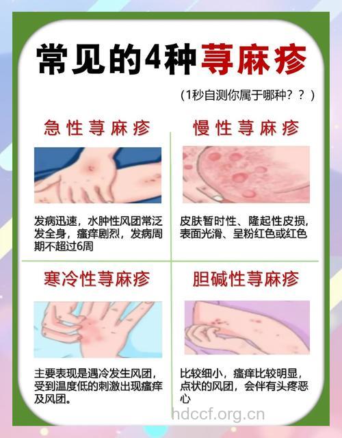 慢性荨麻疹4个常识