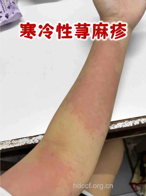 冷风“吹”出荨麻疹