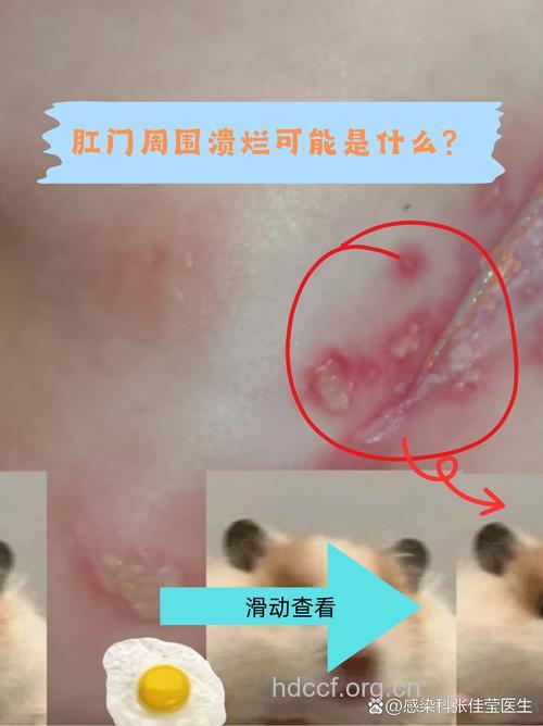 肛裂不及时治疗小心导致肛门溃疡