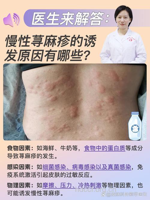 慢性荨麻疹导致因素有哪些