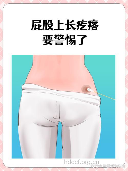 T型裤穿久了会导致痔疮吗