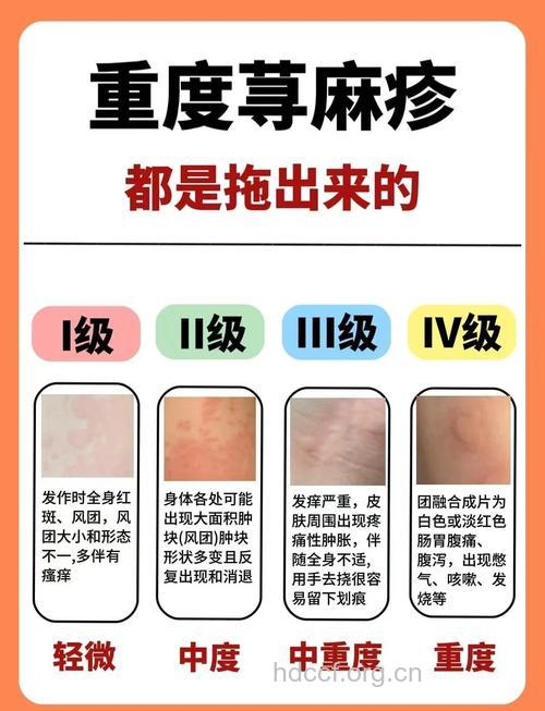 荨麻疹主要有哪些类型