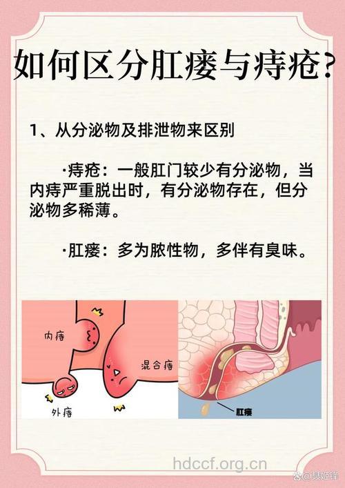 外痔疮和瘘疮如何区别