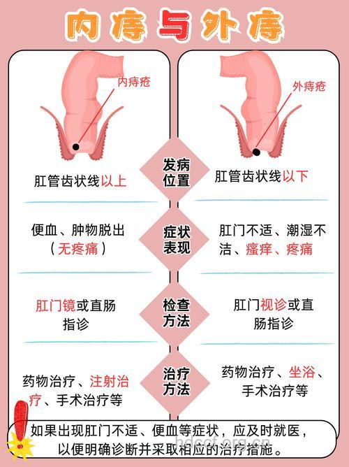 区分内痔和外痔的方法