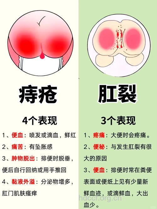 青少年痔疮与肛裂有哪些区别