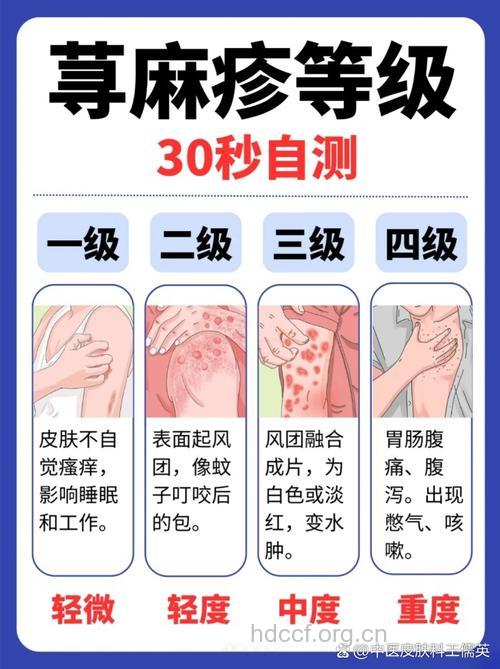 丘疹性荨麻疹的止痒好方法具体有哪些？