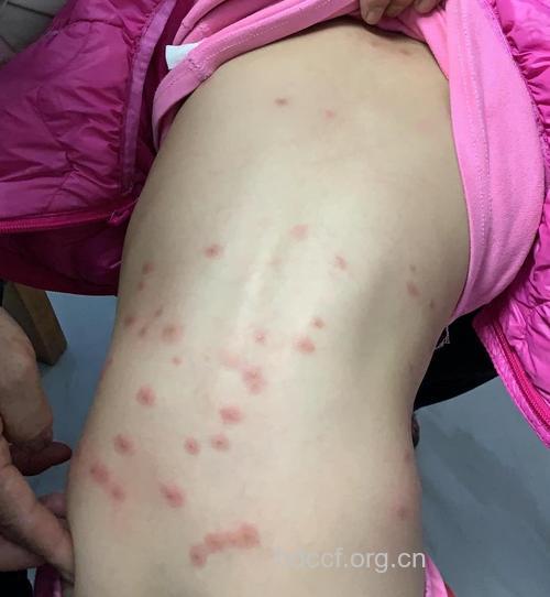 丘疹性荨麻疹的早期症状都有哪些呢？