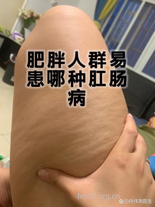 身体肥胖更易患肛肠疾病吗