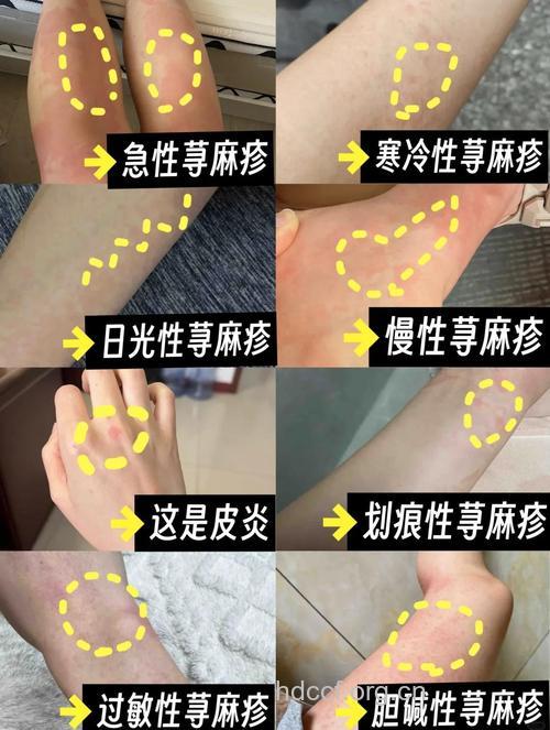 荨麻疹主要有哪些症状