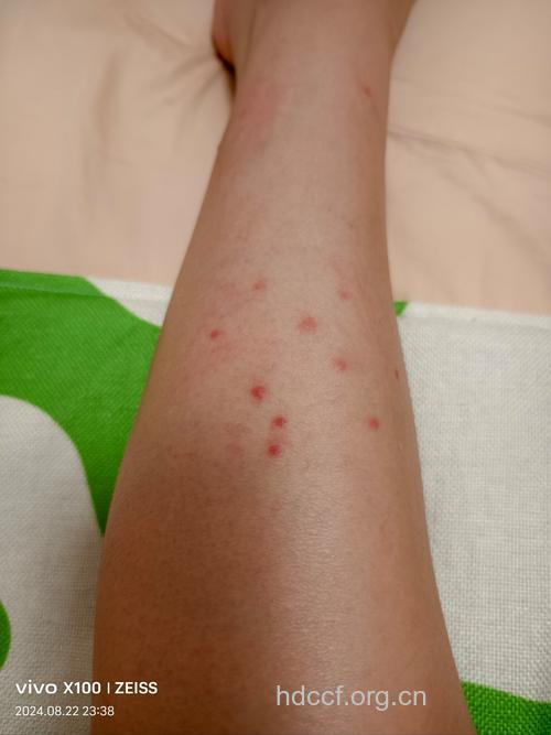 丘疹性荨麻疹症状