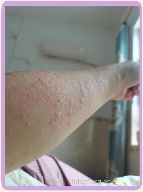 顽固性荨麻疹