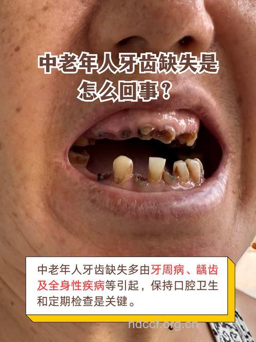 老年人易发的几种牙齿疾病