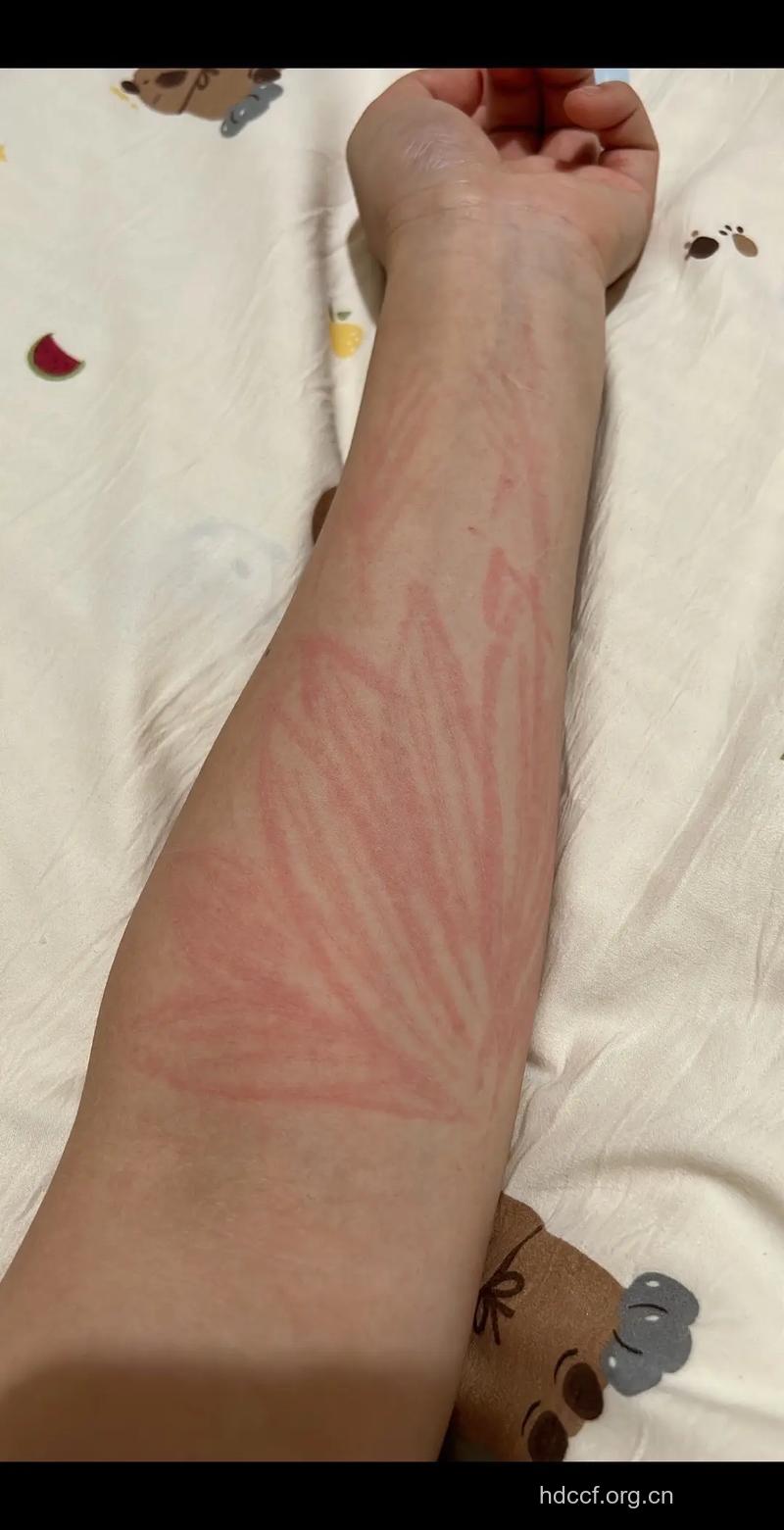 人工荨麻疹的症状