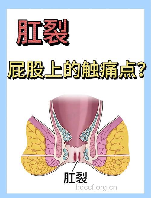 减肥也会发生肛裂吗