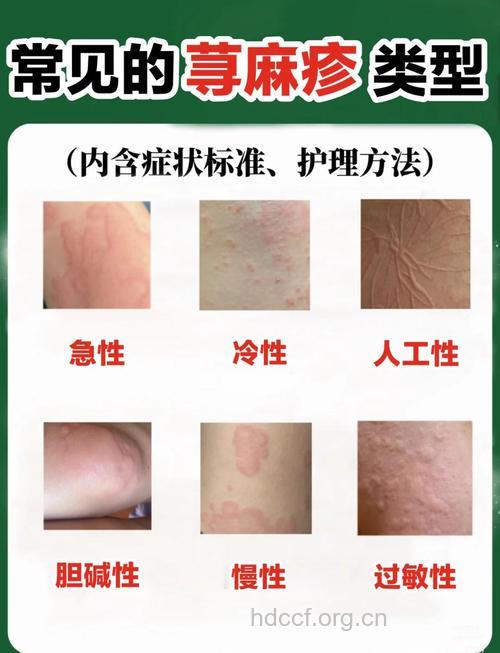 荨麻疹症状有哪些特点